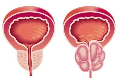 Prostanix gambaran umum